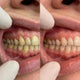 Before and after comparison of teeth with collagen treatment.